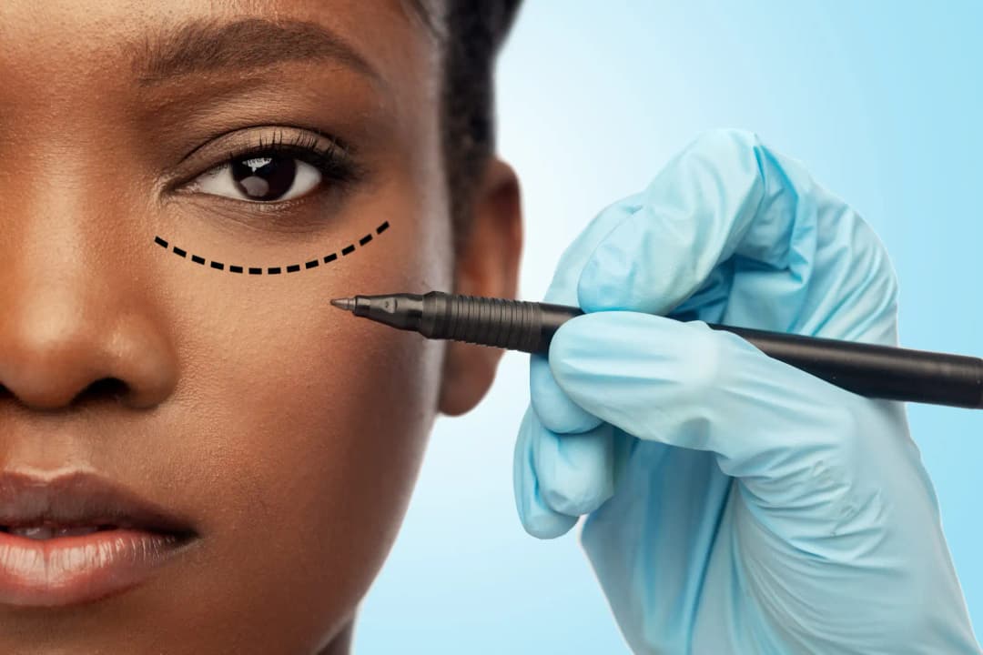 Blepharoplasty
