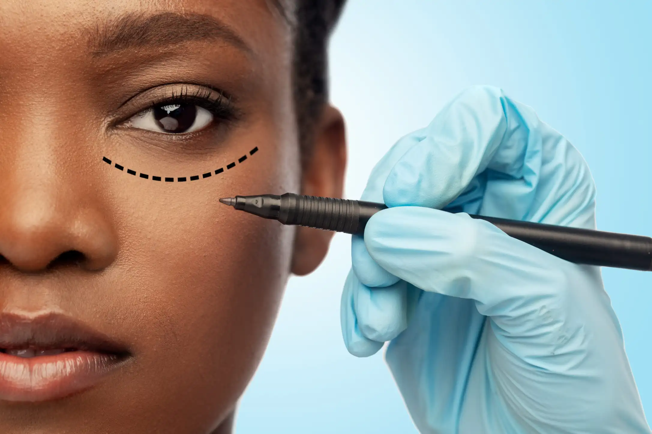 Blepharoplasty