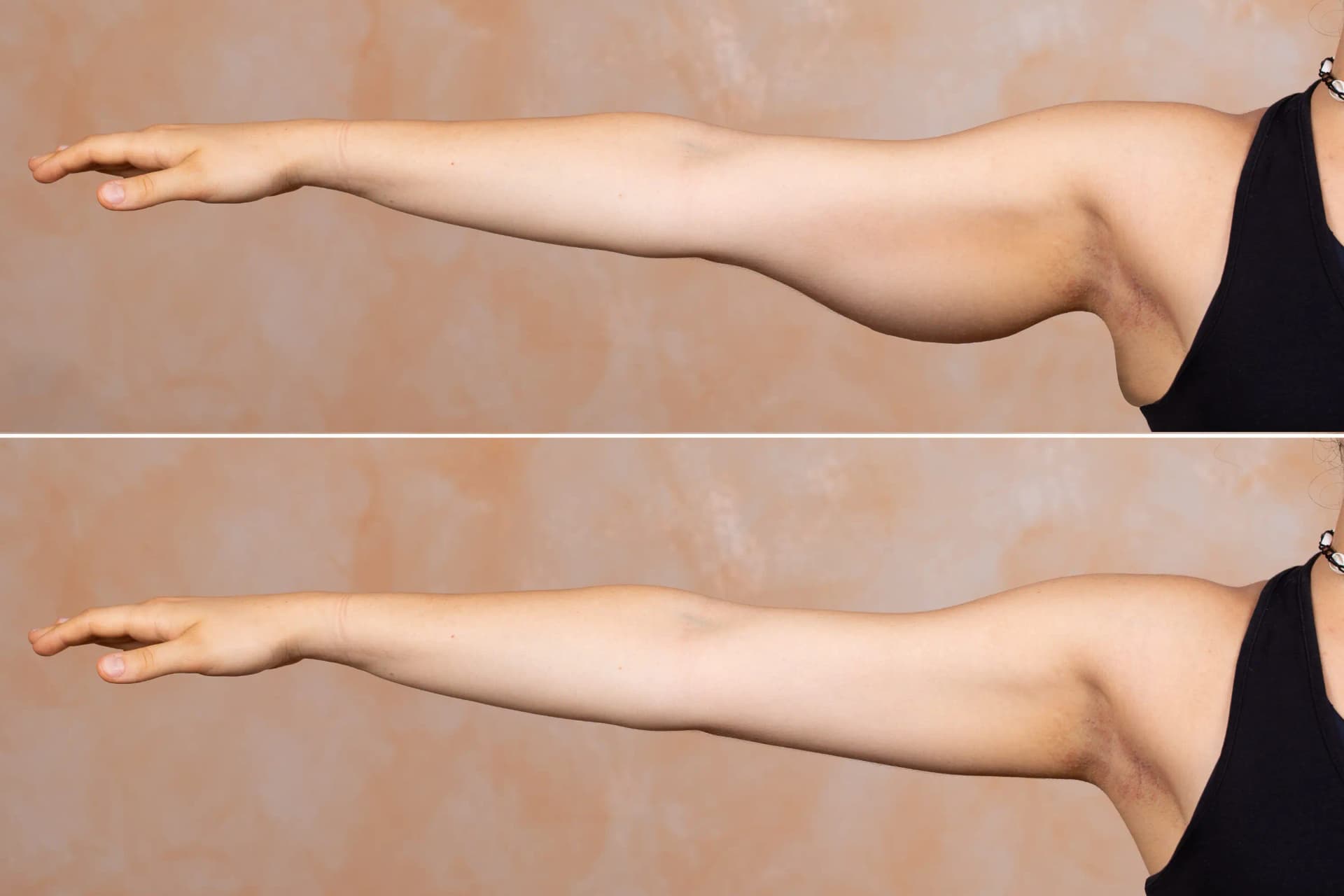 Brachioplasty