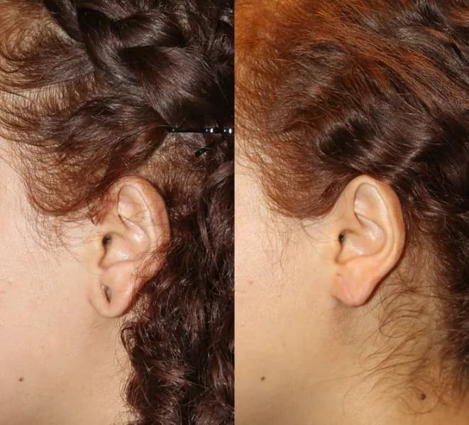 Earlobe Repair